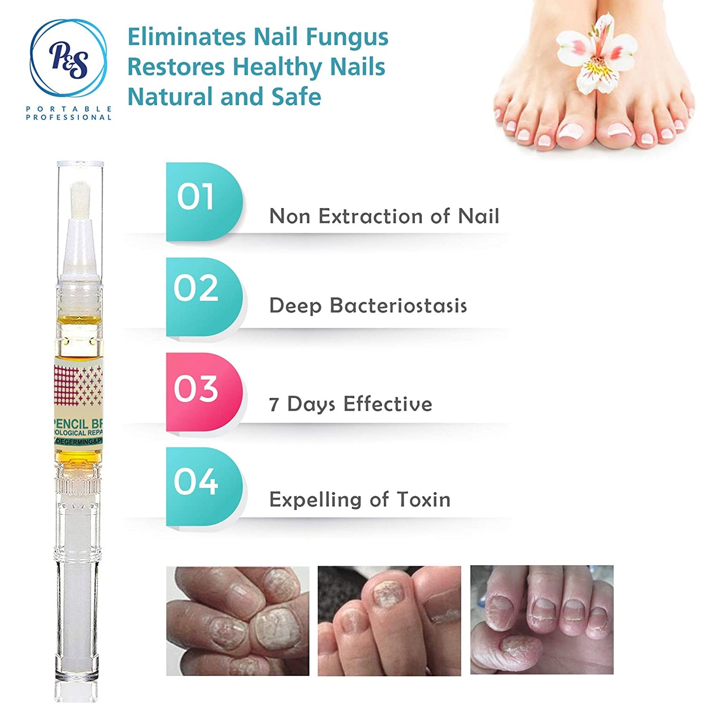 Nail Repair Pen for Toenail and Fingernail, Effective Toe Nail Renewal Solution Extra Strength, Renew Nail Discoloration, Irritations and Ingrown Toenail, Restoring Healthy Nails