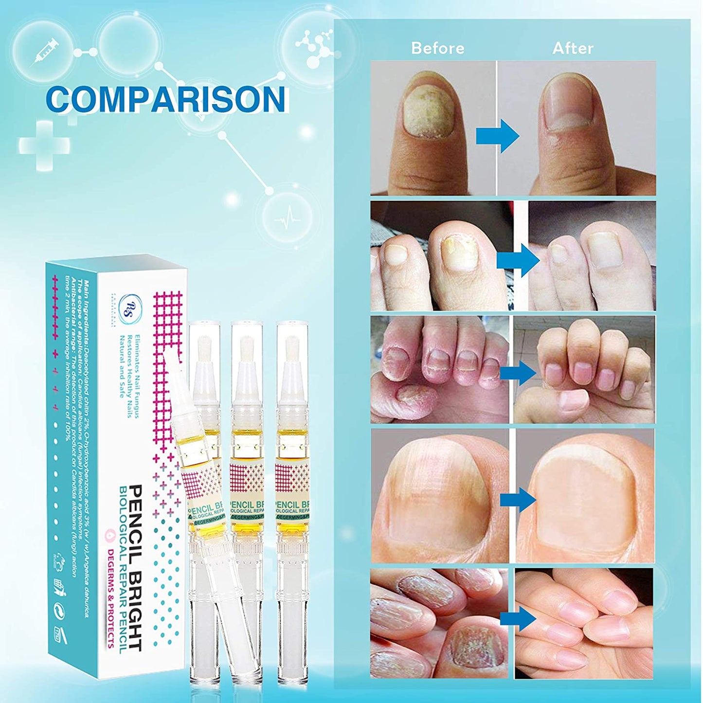 Nail Repair Pen for Toenail and Fingernail, Effective Toe Nail Renewal Solution Extra Strength, Renew Nail Discoloration, Irritations and Ingrown Toenail, Restoring Healthy Nails